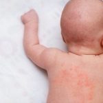 Treating Baby Rashes