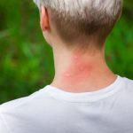 insect bites on kids