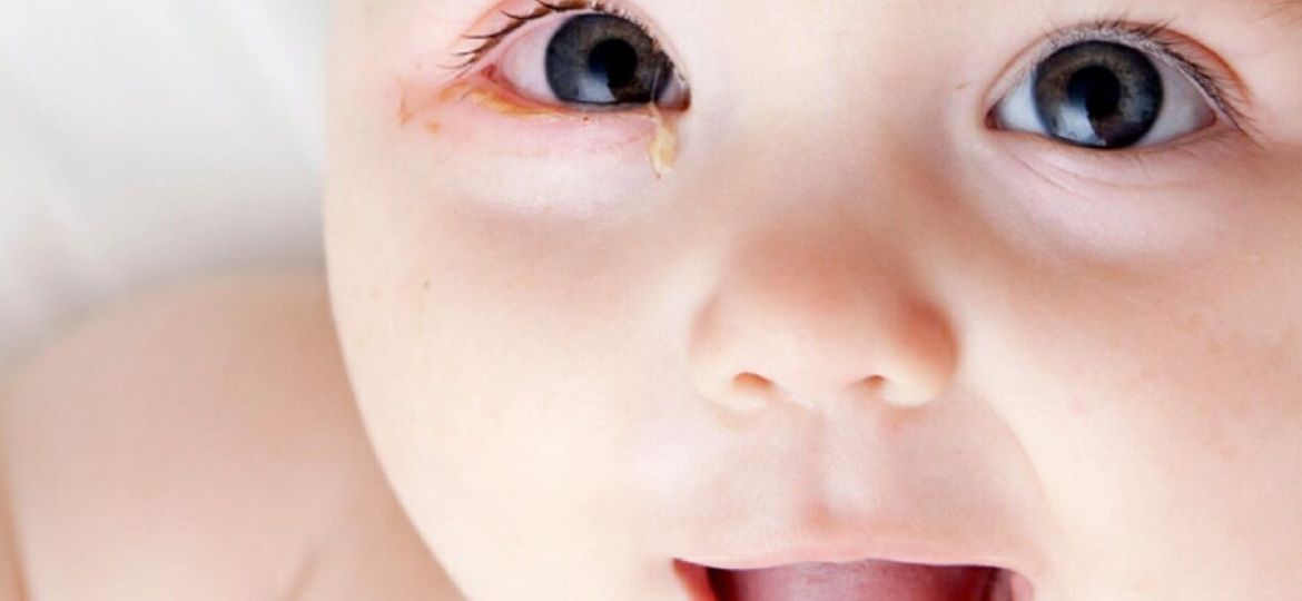 Infant Pink Eye: When To Seek Medical Attention: Pediatrician's Advice